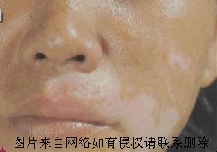 白癜风治疗的科学方法有什么